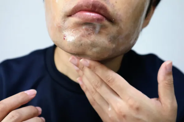 removal cream
