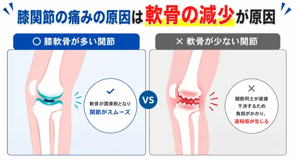 膝関節サプリおすすめBEST5_一度すり減り始めると自然には回復しにくい