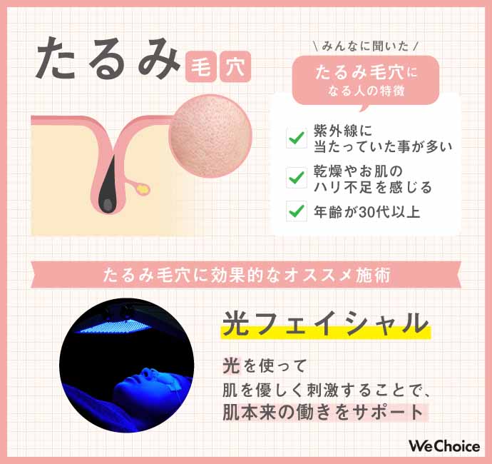 たるみ毛穴